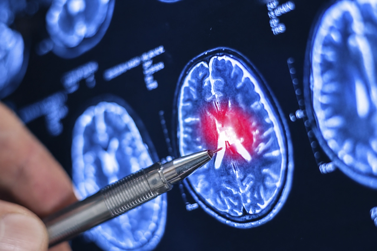 Estudio de imagenología cerebral por resonancia magnética para el diagnóstico de cáncer y análisis de lesiones.