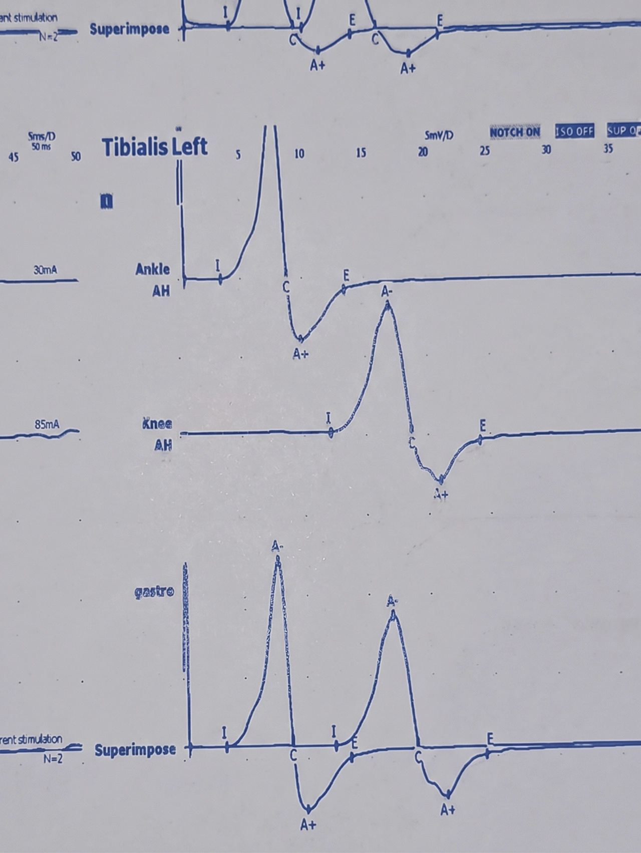 Resultados de estudios de electromiografía, donde se ven impresas las líneas que indican la no presencia de daño. Resultados de estudios de electromiografía, donde se ven impresas las líneas que indican la no presencia de daño.