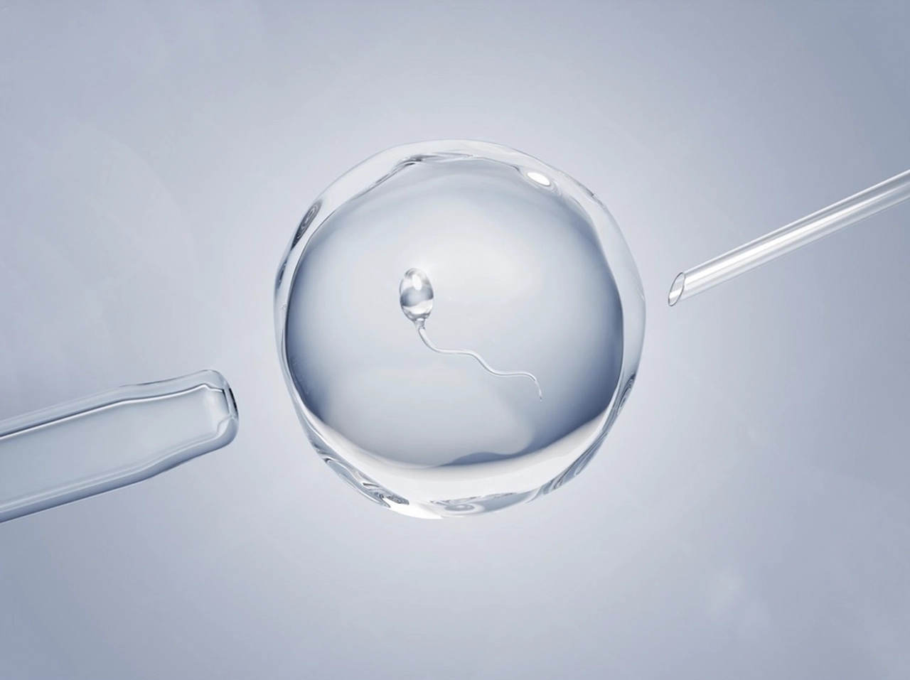 Proceso de fecundación in vitro mediante microinyección espermática como técnica de reproducción asistida en SOP y embarazo. Proceso de fecundación in vitro mediante microinyección espermática como técnica de reproducción asistida en SOP y embarazo.